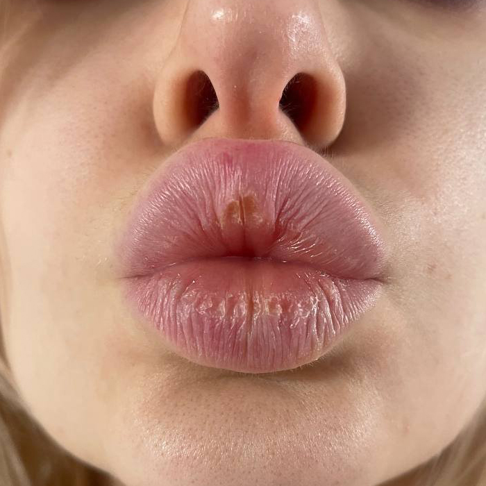 До: Сухість та тріщини